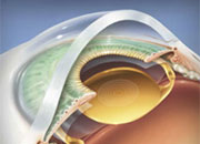 лечение катаракты замена хрусталика
